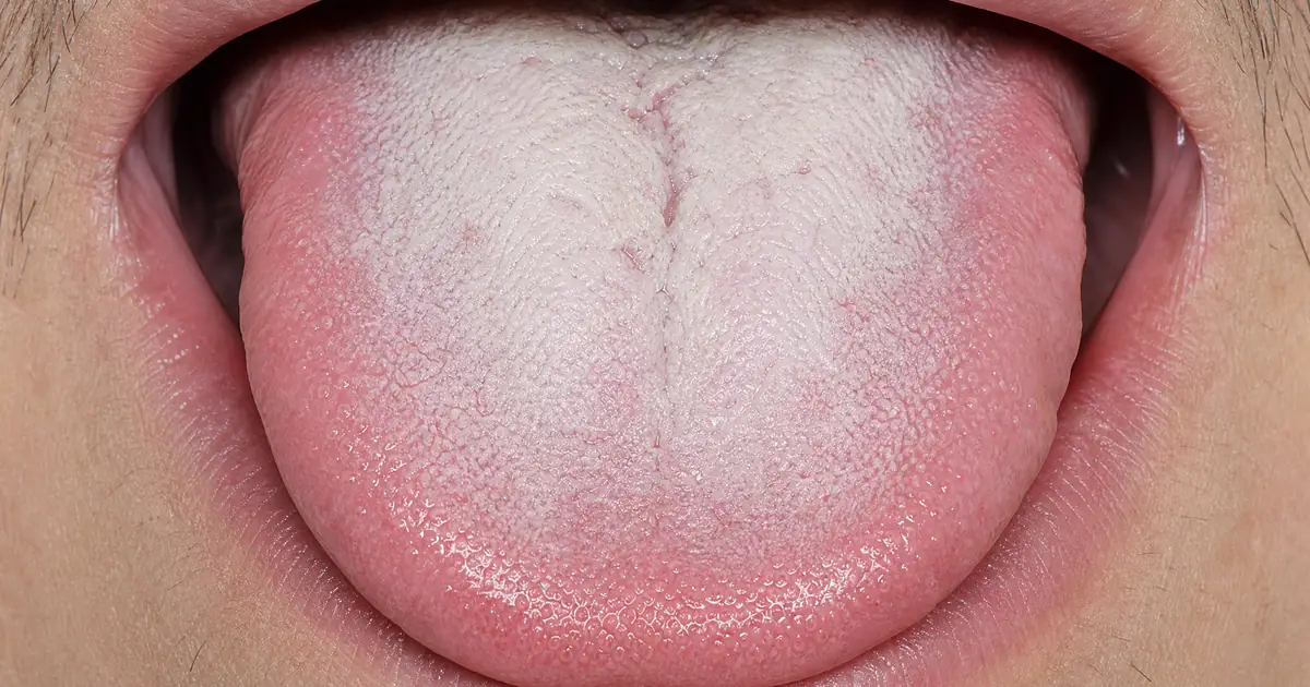 Zyn White Tongue: Why Nicotine Pouches Coat Your Tongue (And How to Fix It)